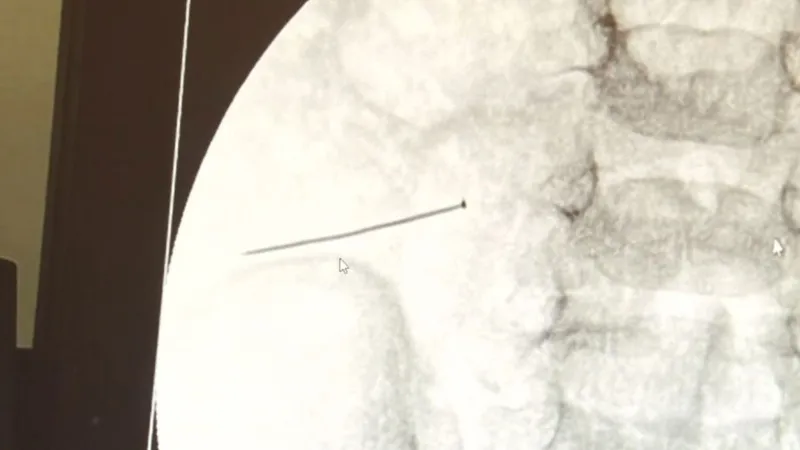 Ağrıdan kıvranan çocuğun karnından 3 santimetrelik iğne çıkarıldı: Bağırsağı delinmiş