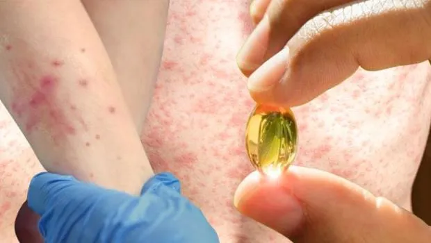 Kızamık Vakaları Artıyor: A Vitamini Tedavide Etkili mi?